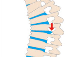 椎間板ヘルニア｜ジョンソン・エンド・ジョンソン メディカル カンパニー